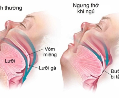 Béo phì và biến chứng ngừng thở khi ngủ
